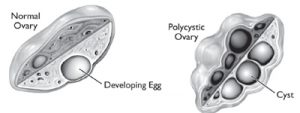 Diagram comparing normal and polycystic ovaries