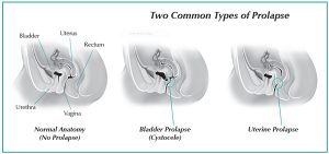 Diagrams of uterine and bladder prolapses