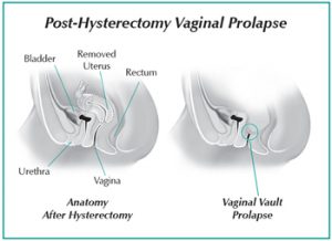 Diagram of Post-hysterectomy vaginal prolapse