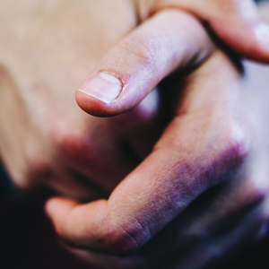 DHEA and Healing Skin Wounds dhea and healing skin wounds
