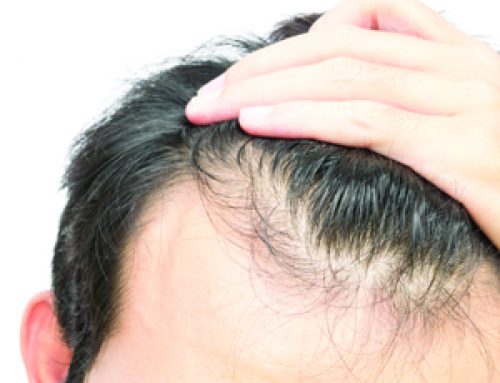 Premature Balding in Men - Women's International Pharmacy Premature Balding in Men - Women's International Pharmacy