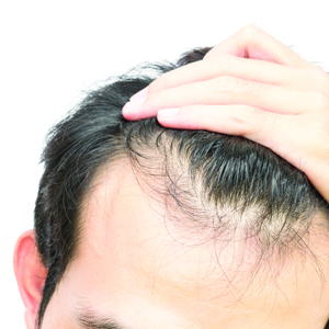 Premature Balding in Men premature balding in men